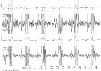 Abbildung 5: QRS-Komplex - Signalmittelung