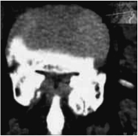 Abbildung 5: Spinalkanalstenose