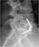 Abbildung 10: Spondylodese