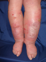 Abbildung 1: Stauungsdermatitis