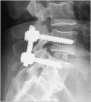 Abbildung 11: Spondylodese