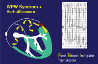 Abbildung 3: WPW-Syndrom