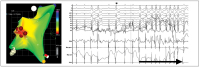 Abbildung 1: Katheterablation