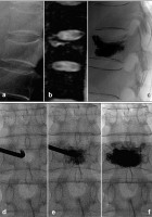 Abbildung 3a-f: Vertebral body compression fracture