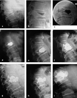 Abbildung 2a-i: Fracture