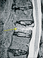 Abbildung 2: Thoracic vertebra