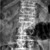 Abbildung 1: Lumbar vertebra