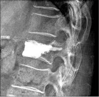 Abbildung 4: Lumbar vertebra