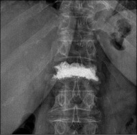 Abbildung 5: Lumbar vertebra