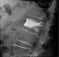 Abbildung 6: Lumbar vertebra