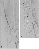 Abbildung 1a-b: Verschluss der distalen Arterie femoralis superficia'is
