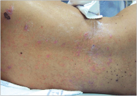 Abbildung 2: Epidermisabhebung