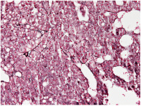 Abbildung 4: Histologie aus Leberstanzbiopsien
