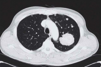 Figure 3: Thoracic CT