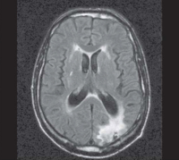 Figure 4: FLAIR-MRI