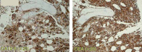 Figure 3: CA 19-9 - CEA