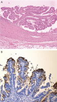 Abbildung 2a-b: Neoplasie