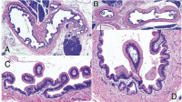 Abbildung 3a-d: Neoplasie
