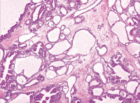 Abbildung 5: Neoplasie
