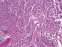Abbildung 6: Neoplasie