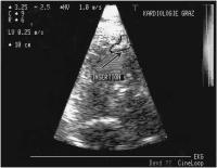 Figure 2: Koronarfistel