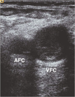 Abbildung 4: Venous thrombosis