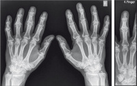 Abbildung 2a-b: Arthrose