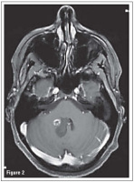 Figure 2: Brain Tumour