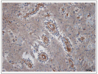 Figure 5: Brain Tumour 