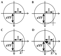 Figure 1: QRS Complex