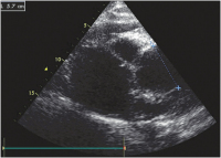 Abbildung 2: Aneurysma Aorta ascendens