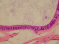 Abbildung 3: Appendix - Neoplasma