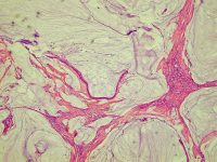 Abbildung 4: Pseudomyxoma peritonei