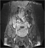 Abbildung 1: VCI - Thrombose