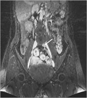 Abbildung 2: Antikoagulation - Restthrombose