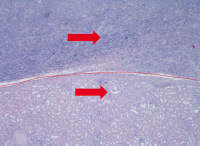 Abbildung 4: Lymphom