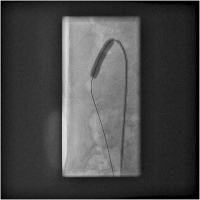 Abbildung 2: Stentangioplastie