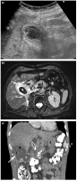 Abbildung 2a-c: Cholecystis