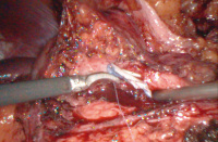 Abbildung 2: Transplantat