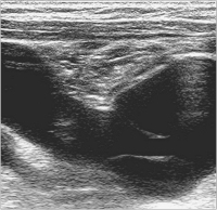 Abbildung 2: Aneurysma