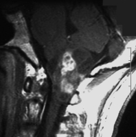 Figure 1: Brain tumour