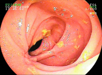Abbildung 4: M. Crohn 
