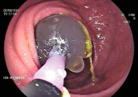 Abbildung 5: M. Crohn