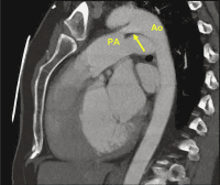 Abbildung 8: CT-PDA