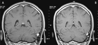 Figure 4a-b: Brain MRI