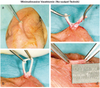Abbildung 1a-d: Minimalinvasive Vasektomie