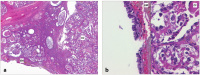 Abbildung 1a-b: Adenocarcinoma