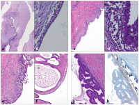 Abbildung 2a-h: Ovarian endometriosis