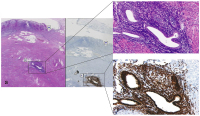 Abbildung 6: Endocrinically active endometriosis