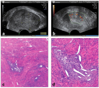 Abbildung 13a-d: Adenomyosis uteri interna